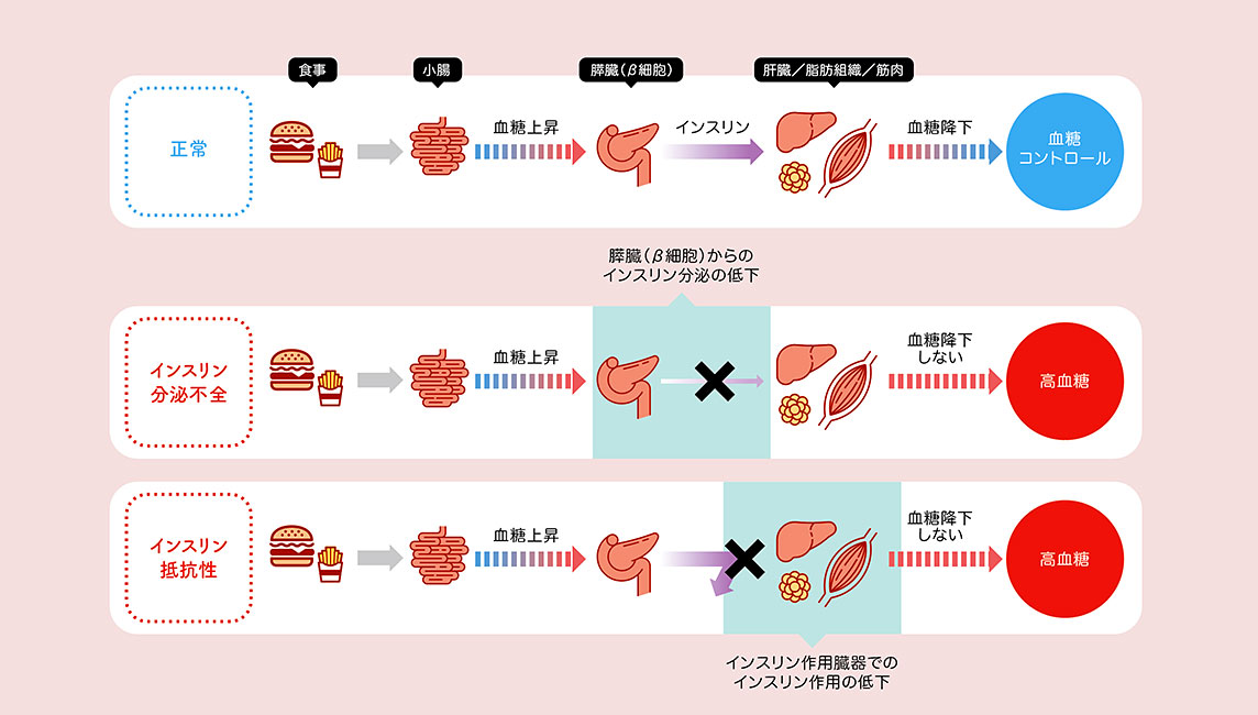 世界の糖尿病増加を食い止める